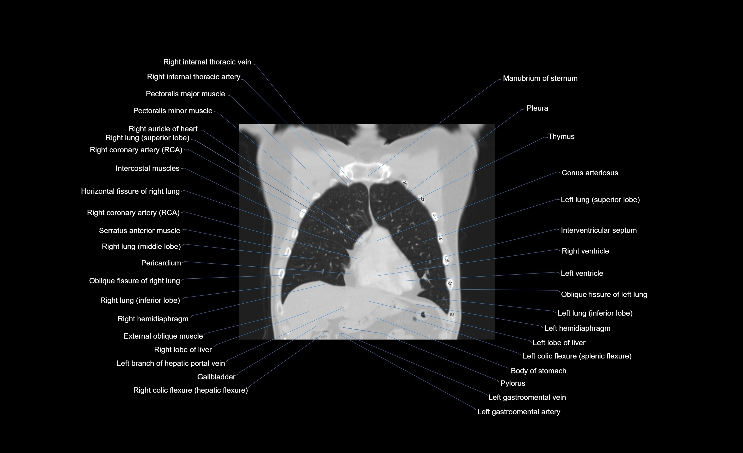 CT chest (thorax) lung window window labelled coronal cross sectional anatomy radiology image-00088.webp